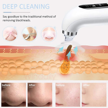 Blackhead Remover / Machine USB Rechargeable